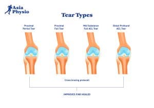 Spectrum Of ACL Tears